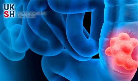 UKSH Aktionstag Darmkrebs